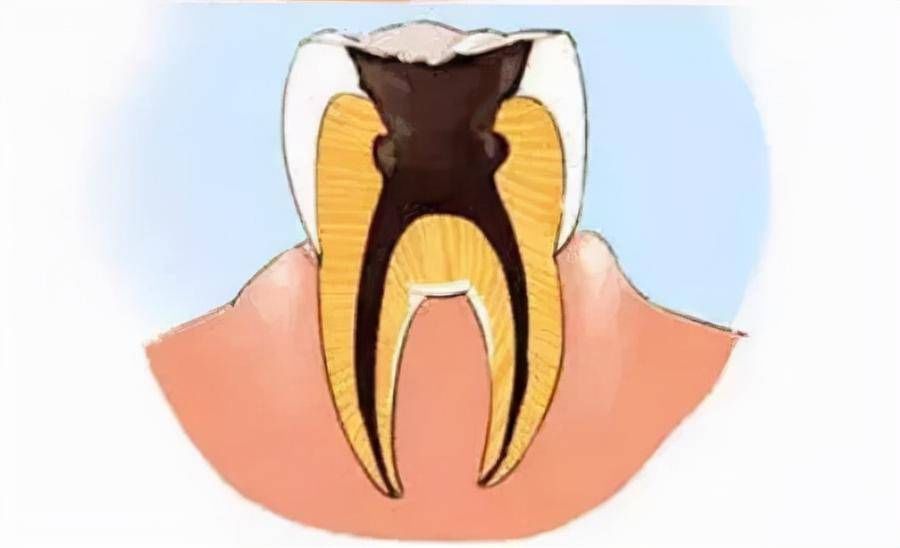 牙齿|杭州美莱口腔健康科普：蛀牙很久不管会有什么后果