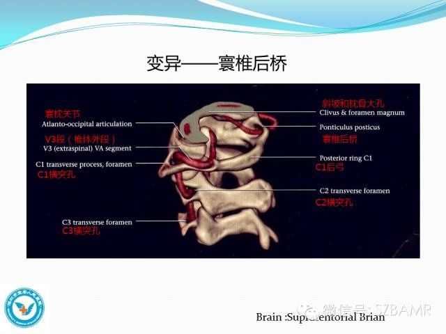 mr|椎-基底动脉系统解剖