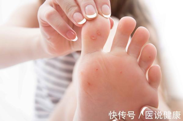 皮肤|糖尿病患者,可能会出现6种皮肤病变,发现后,及时控制血糖