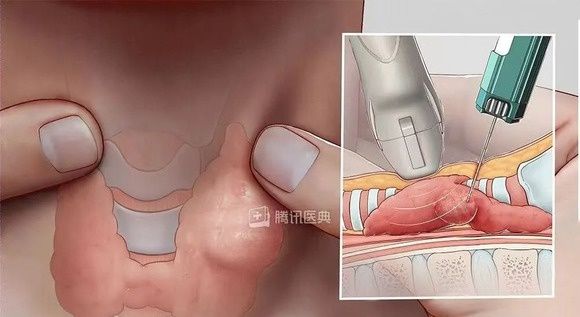 气管|甲状腺分级到底是什么？