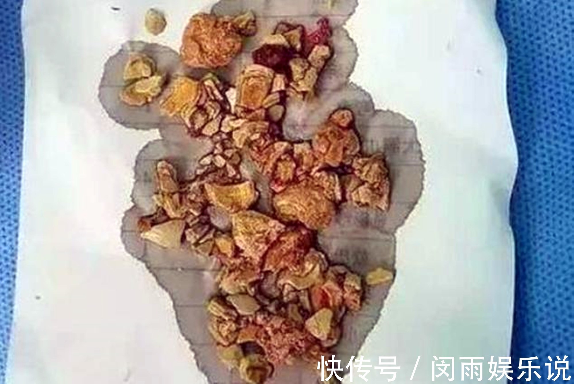 苦口婆心|儿科医生苦口婆心:孩子2岁前有6种辅食再馋别吃,易积食还不长个