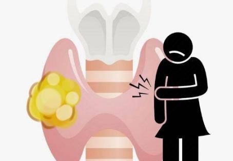 特征|甲状腺结节“癌变”时，并不是悄无声息，出现3个特征需提高警惕
