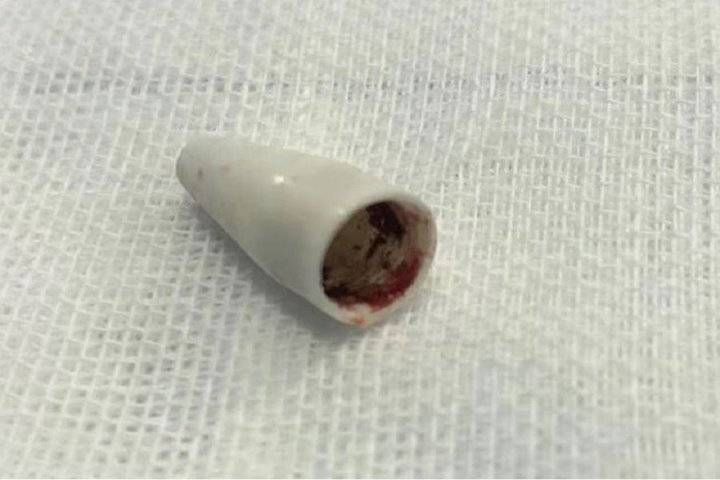 健康过春节|耳鼻咽喉头颈颅底外科:谨防食管异物及小儿气管异物