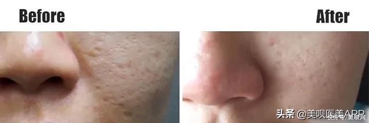 爱豆们竞当医美达人？男性适合的轻医美项目top5合集