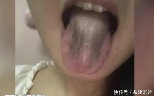 虚劳病|29岁女子,肾衰竭离世,医生解释吃饭时1个习惯害的