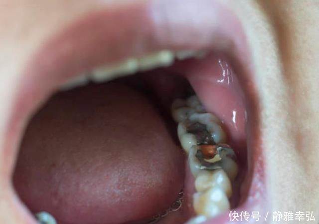 吃糖|10个5岁儿童中，7个有龋齿，罪魁祸首居然不是糖？