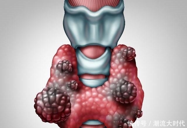 现甲状腺结节以后|甲状腺结节需要做手术吗?做好2件事,结节可能会慢慢“变小”
