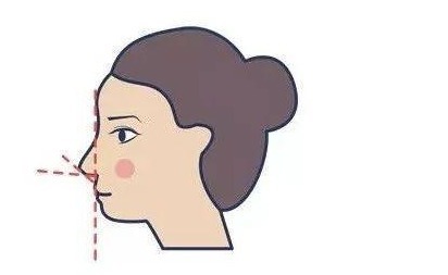 肋软骨 想做隆鼻手术,医生居然要取我的肋骨?