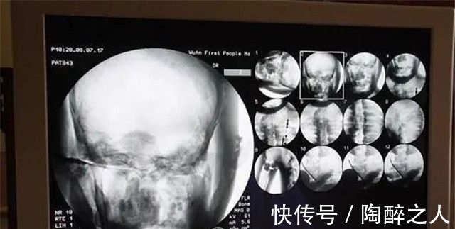 秘密|中国河北高僧去世后,肉身为何千年不腐?专家用X光照后发现秘密