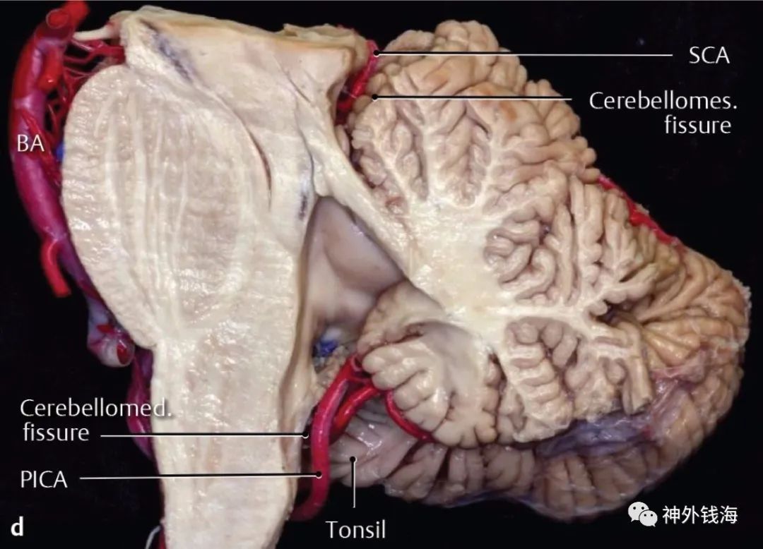 小脑扁桃体|一例脑干海绵状血管瘤的手术陷阱