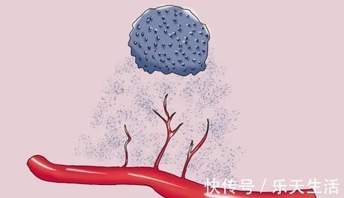 癌症骨转移|癌症出现骨转移，说明已经进入晚期，无法治愈了吗？医生解答了