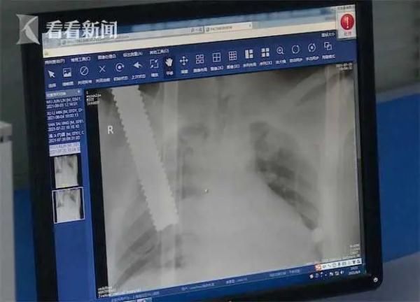 胸部|太吓人！男子遭“天降”铁棒穿透胸部击破心脏...