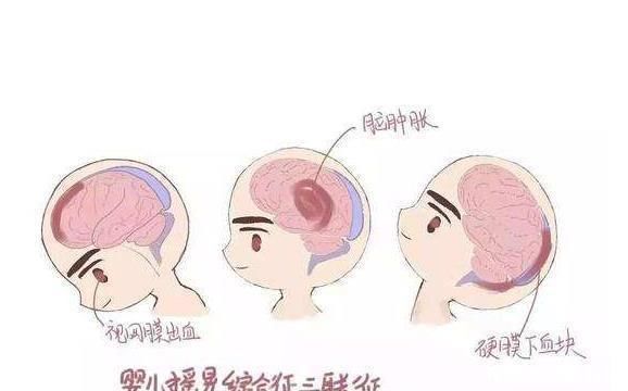 婴儿|婴儿突发脑出血,医生揭露了罪魁祸首,很多父母都在犯!