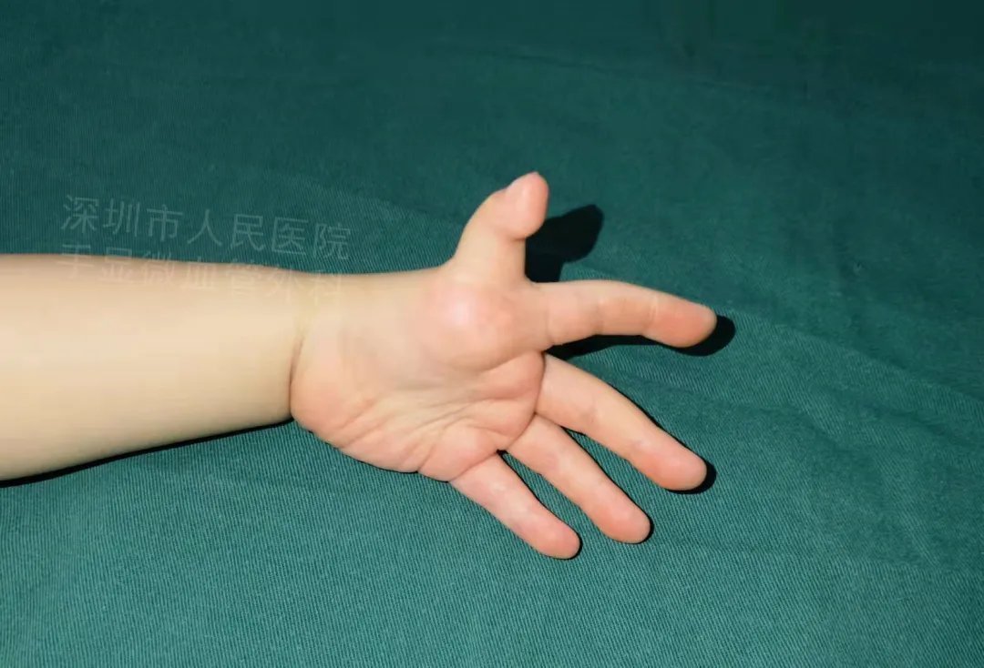 发育不良|得了这病,12岁男孩手指比香蕉还粗!7种常见的手部畸形,家长们要注意