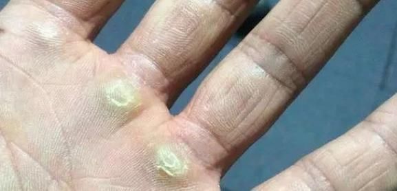 修剪|脚上长“茧子”和疾病有关？若脚上出现4种茧子，一定要留意了！