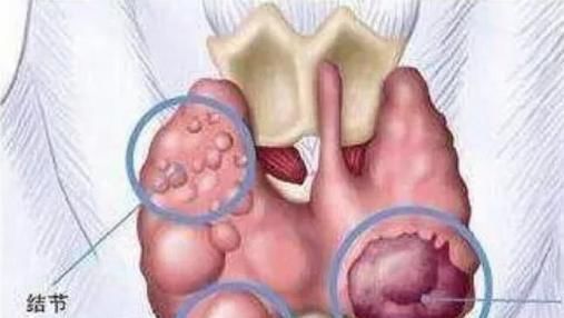 适合甲状腺结节的几个小动作,经常做起来,促