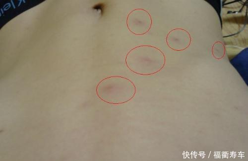 身上长了许多 小红点 可能是身体发出的 求救信号 快资讯 身上长了许多 小红点 可能是身体发出的 求救信号 快资讯