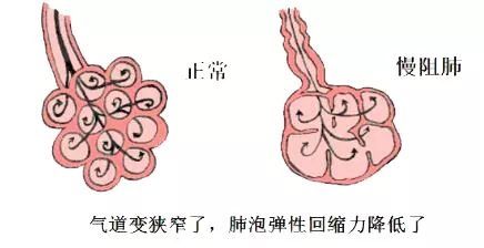 慢性阻塞性肺疾病|提醒！这个季节咳嗽、咳痰千万别忽视，当心被这个病盯上！