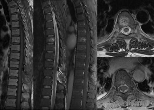 椎体|脊柱常见肿瘤及肿瘤样病变的几种影像学表现,你都见过吗?