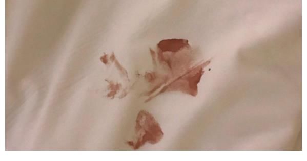 宫颈|HPV出现到宫颈癌，下身有2个“信号”，若没有，恭喜宫颈健康