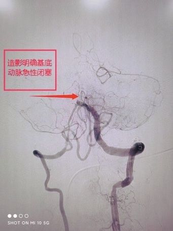 闻华|沈阳六院成功救治一例脑卒中患者