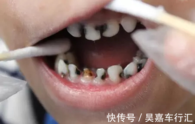 家长会|让孩子“烂牙”的不是糖,是家长无知!3种错误行为,一定要避免