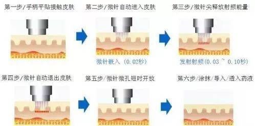 肌肤|济南海峡整形分享：微针你都了解吗？