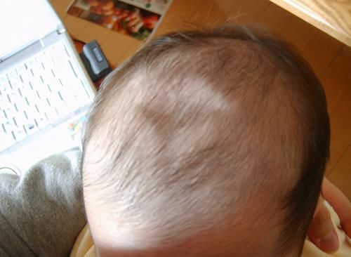 大脑|宝宝卤门护理有多重要?如果出现这些情况,要尽快带娃去医院