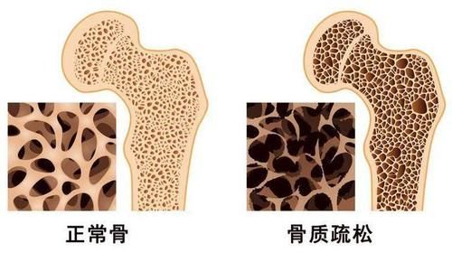 骨量|养骨其实很简单，生活中做好这“3事”，或可让骨质疏松远离你