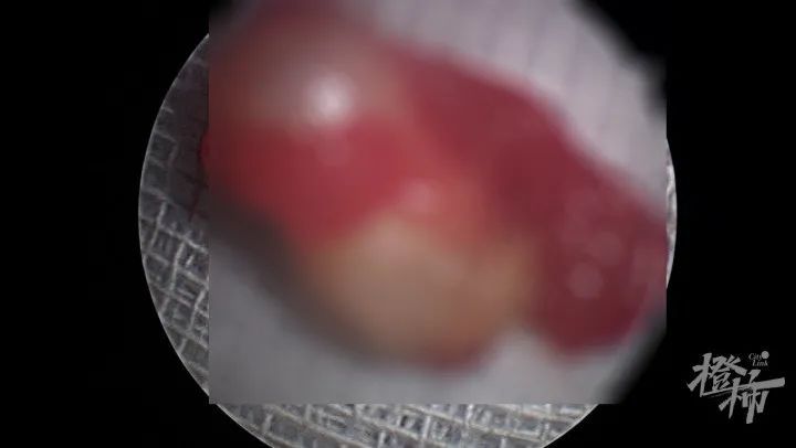 女孩|6岁女孩鼻子里长了颗牙？家有换牙期小朋友的家长注意了