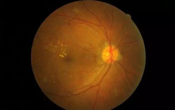 心脑血管|血压高的人,身体会有3个异常,若没有,说明血压控制得还不错