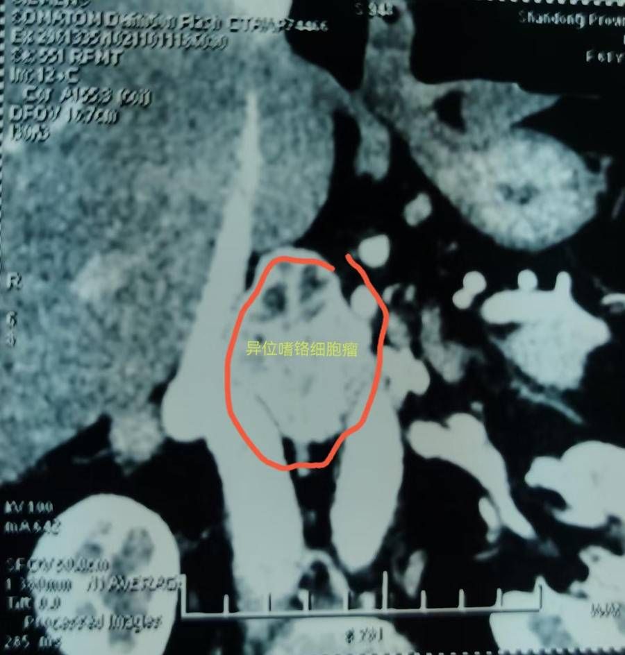 肿瘤|惊险！致命大血管包绕异位嗜铬细胞瘤 省立医院突破性成功切除