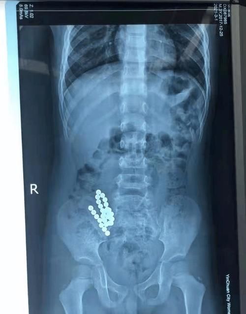 惊丨银川3岁男童吞下31颗磁力珠，手术取出竟连成“彩虹”手串！