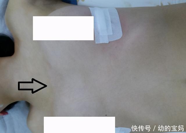 村里的孩子诊断为鸡胸,是缺钙引起的吗?如何预防孩子鸡胸?