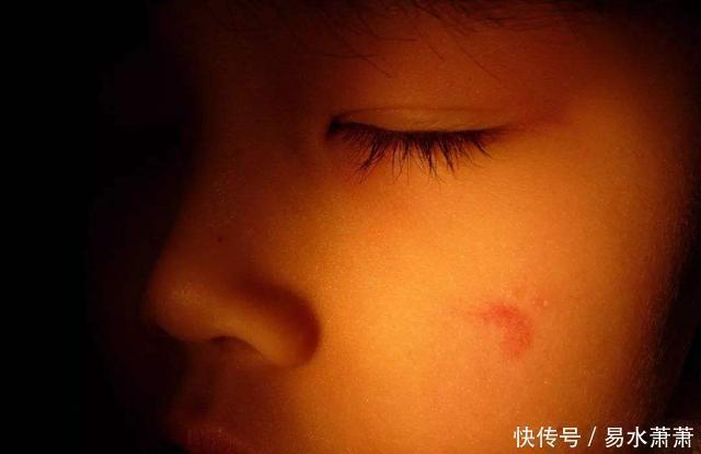 李女士|为什么有的宝宝会有“胎记”产科医生孕期要避免这3种行为