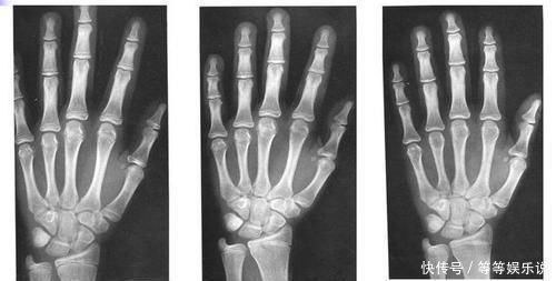 喉结|男孩不怎么长个,是发育晚还是本身长不高?有4个特征可安心