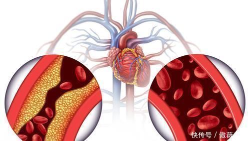 人群|不同人群的高血压，降压药选择不同，千万别选错！