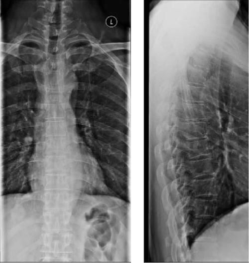 椎体|脊柱常见肿瘤及肿瘤样病变的几种影像学表现,你都见过吗?