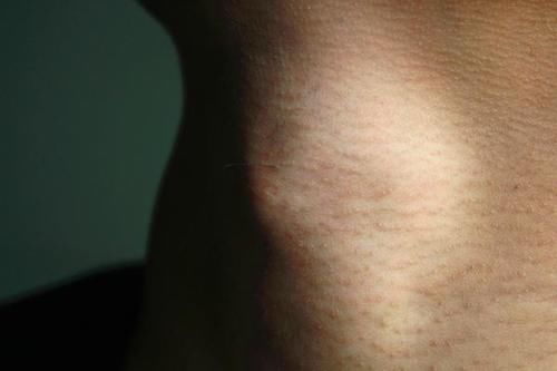 动脉|颈动脉狭窄,应该怎么办?放支架,还是继续吃药?医生说清楚