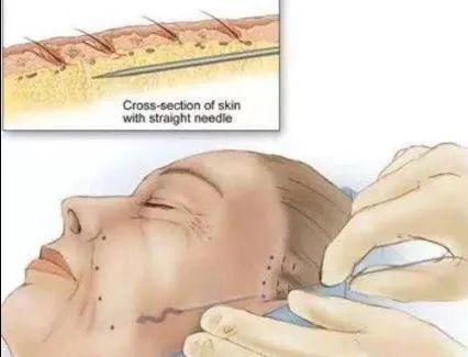 洛阳华美|可怕！女子术后脸上长包，大夫说上火，吃药一个月后，竟从脸上揪出……