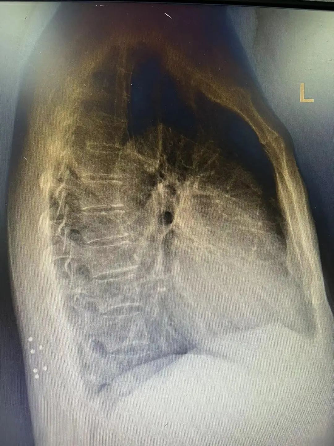 邓伯|60岁老伯空手过安检警报响不停,一查问题竟出在30年前