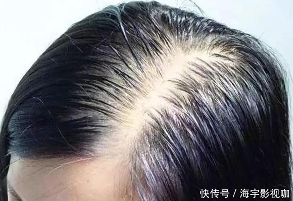 祛濕|濕氣引百病，濕氣分為4個等級，看看你的濕氣達到了幾級