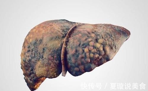 末梢神经|44岁男子滴酒不沾,查出肝硬化,提醒要注意身体3种“异常”