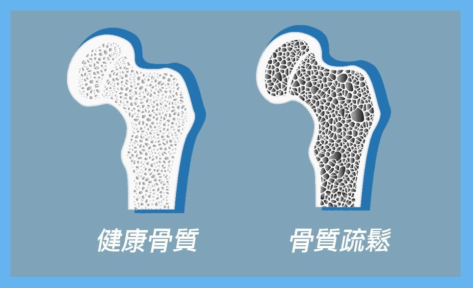 食盐|年龄越大，骨头越松？提醒：远离3物做好3事，骨头强如“金箍棒”