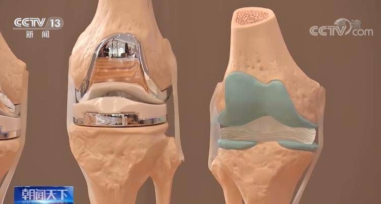 丁一磊|人工关节平均降价82%，集采“国家队”再出手