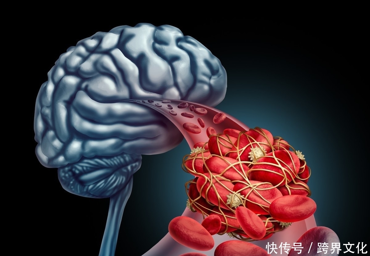 预防复发|为什么脑梗死容易复发?预防脑梗死复发,有什么方法呢?