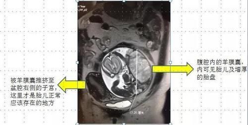 宫外孕|怀孕6个多月,子宫却是空的!孩子去哪儿了?!