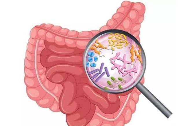 腸癌|52歲男子深夜腹痛送醫查出腸癌，醫生：腸癌從發生到晚期只4步