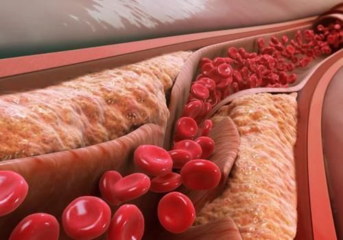 上门|胆固醇“大户”被揪出，不是猪肉，不想脑梗找上门，劝你少吃