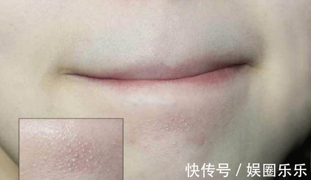 颗粒|抿起下巴凸起的小颗粒和痘痘, 究竟是什么 趁早知道, 否则越长越丑!